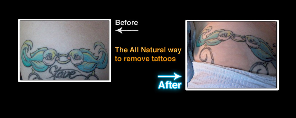 tattoo removal