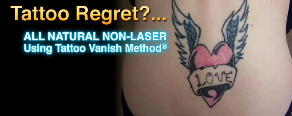 Tattoo Removal