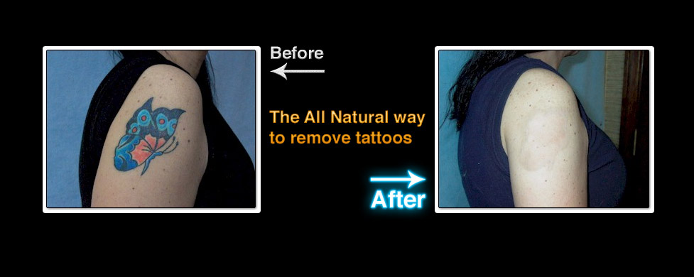 Deleted Scene Tattoo Removal  Great progress on this large neck and  collarbone piece This client has decided to go into the military so we  are removing the entire neck bell and